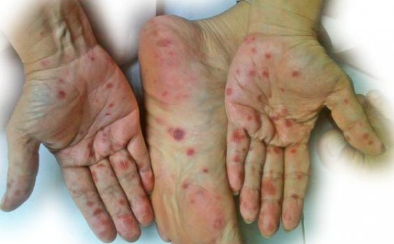 Flu Singapura pada Anak