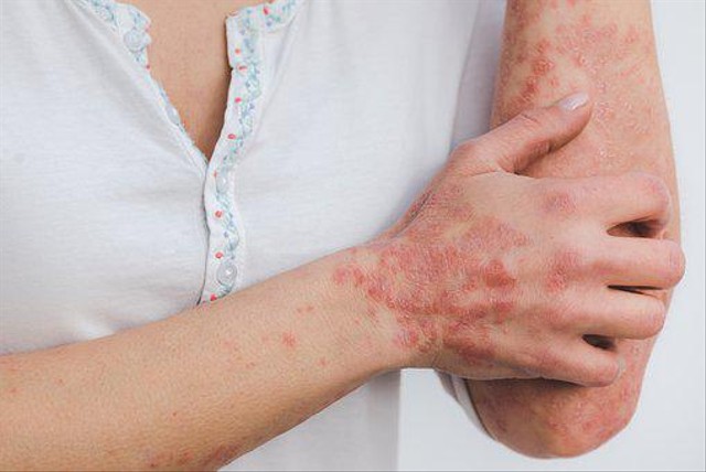 Cara Menghilangkan Gatal di Badan Secara Alami