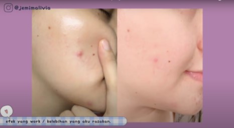 REVIEW Scarlett Whitening Acne Serum Skincare Untuk Kulit Berjerawat review scarlett whitening acne serum Bebas dari Jerawat